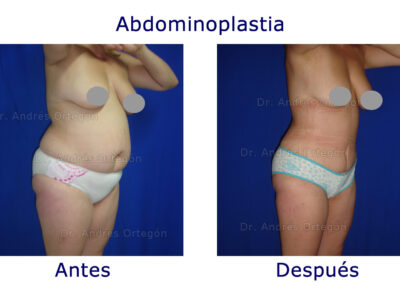 abdominoplastia-1