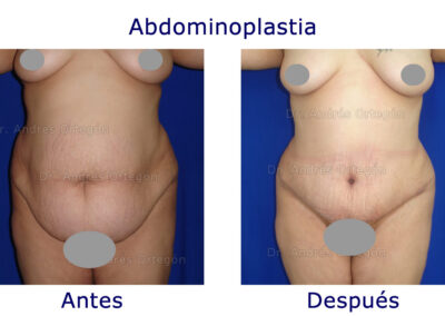 abdominoplastia-2