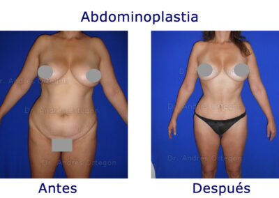 abdominoplastia-3