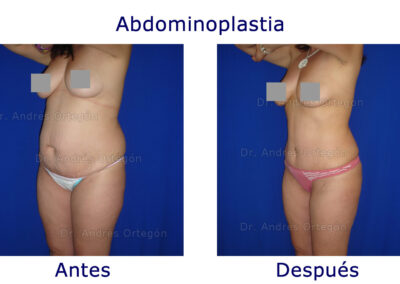 abdominoplastia-4
