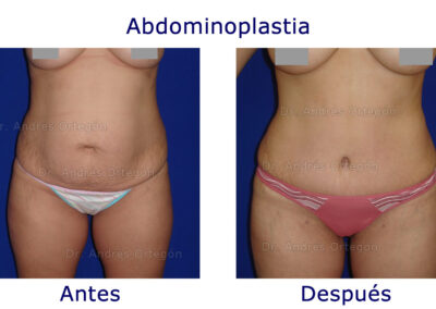 abdominoplastia-5