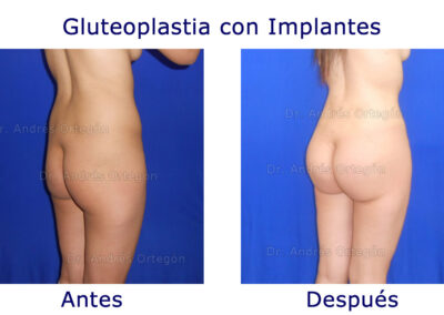 gluteoplastia-2