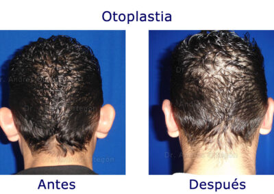 otoplastia-1