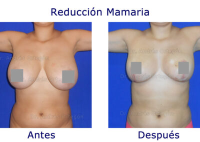 reduccion-mamaria-2