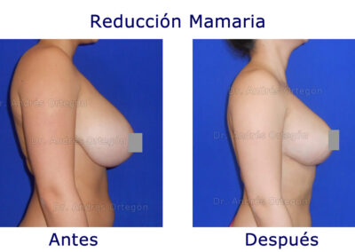 reduccion-mamaria-3