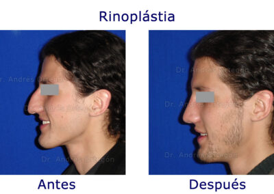 rinoplastia-1