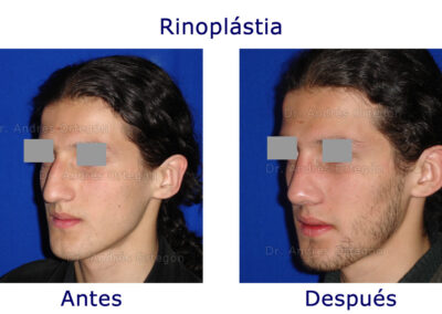 rinoplastia-2