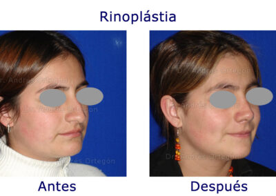 rinoplastia-3