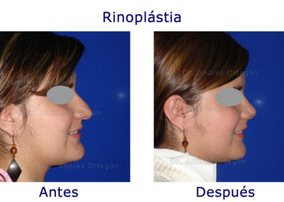rinoplastia-4