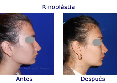 rinoplastia-5