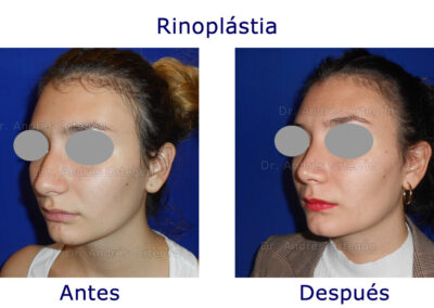 rinoplastia-6