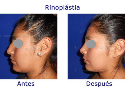 rinoplastia-7