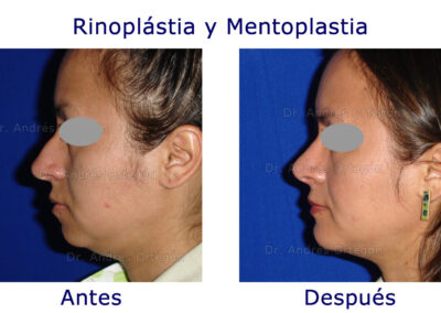rinoplastia-y-menton-1