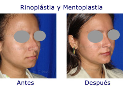 rinoplastia-y-menton-2