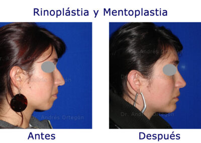 rinoplastia-y-menton-3