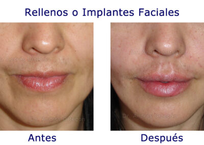 relleno-facial-1