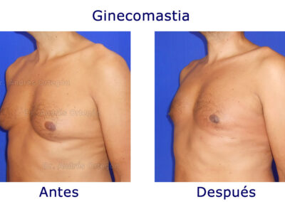 ginecomastia-2
