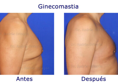 Ginecomastia-3